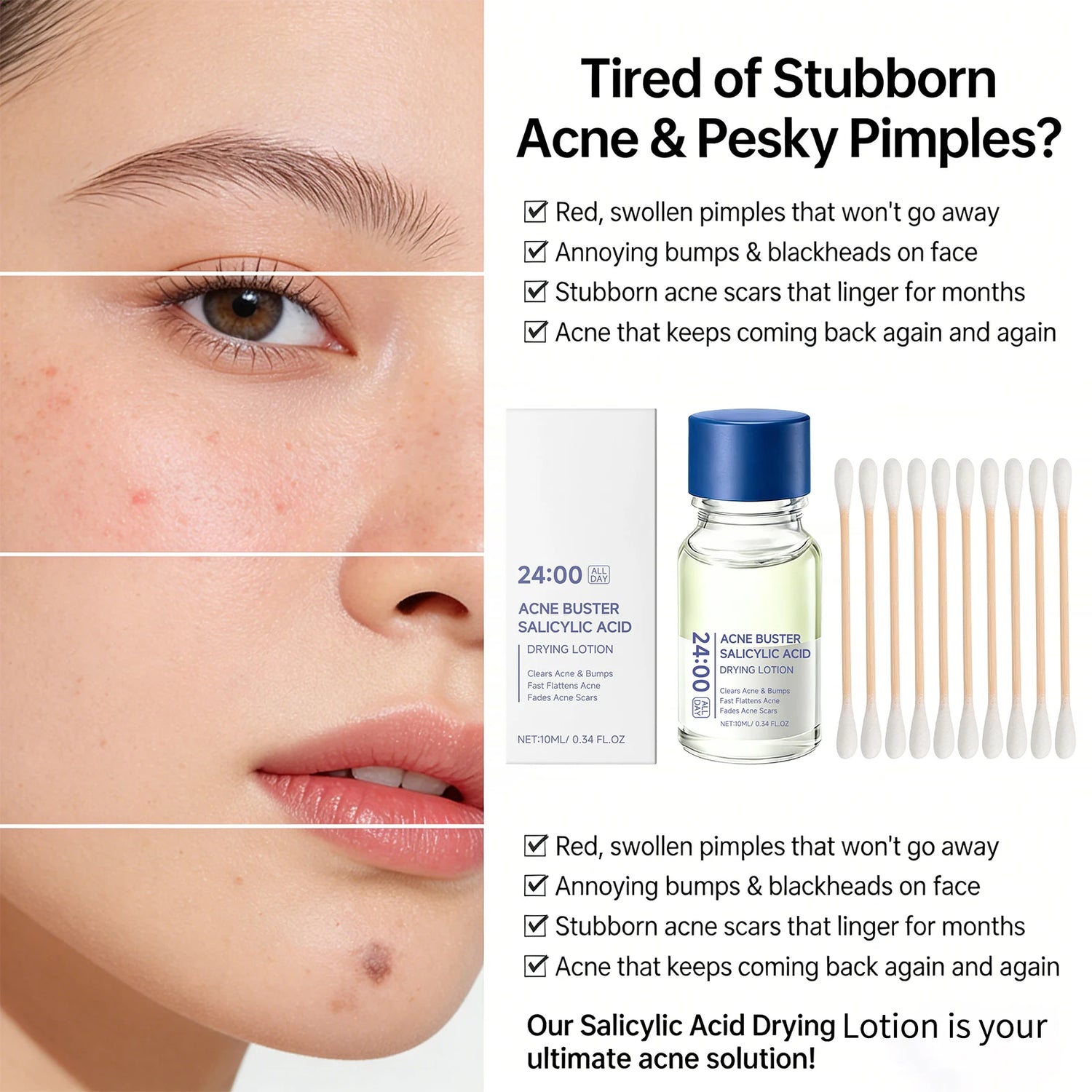 Salicylic Acid Drying Lotion Face Serum with Cotton Swab– Reduce Pimples &amp; Breakouts Fade Acne Scars Minimize Pores Skin Renewal