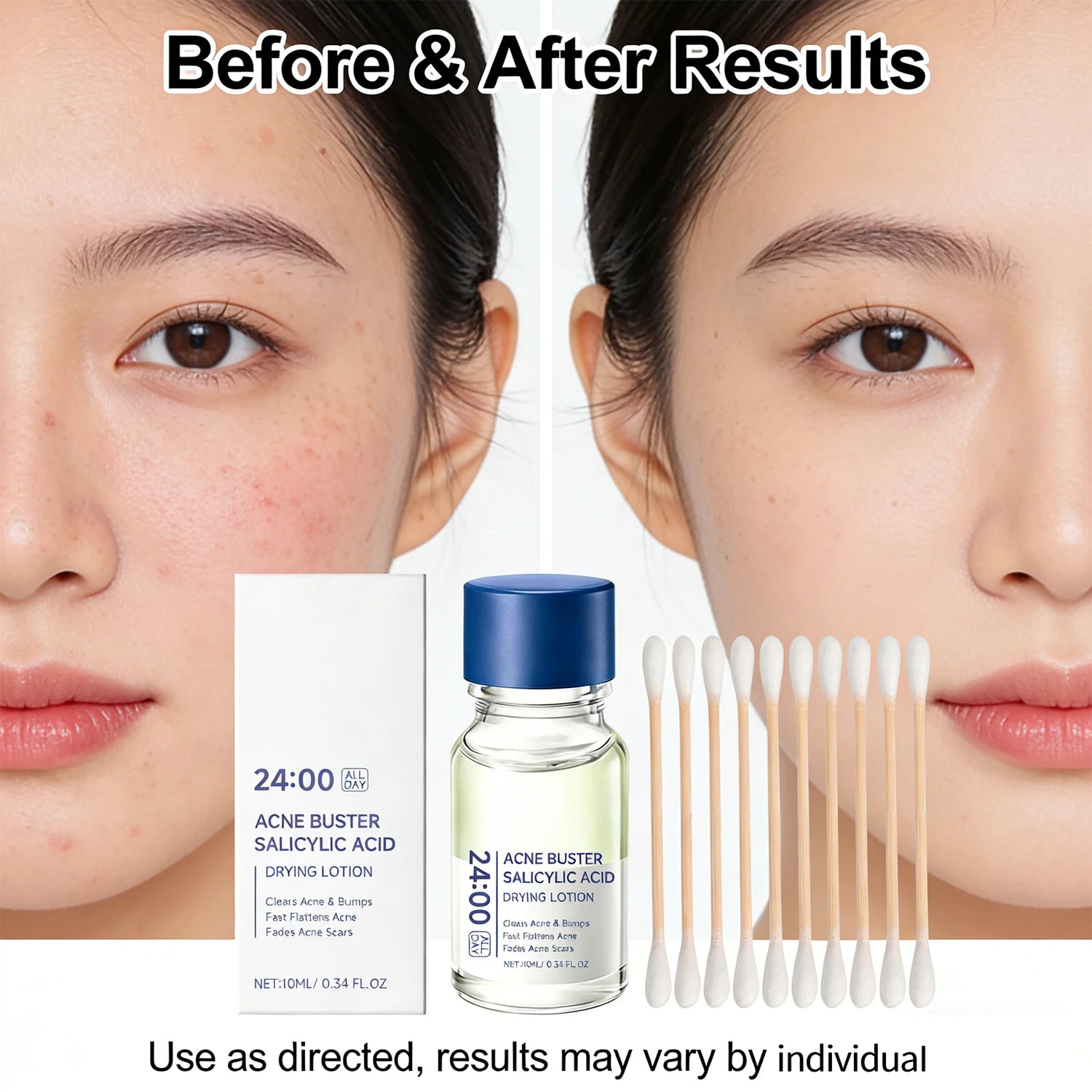 Salicylic Acid Drying Lotion Face Serum with Cotton Swab– Reduce Pimples &amp; Breakouts Fade Acne Scars Minimize Pores Skin Renewal